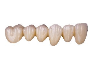 Dental Crowns & Bridges