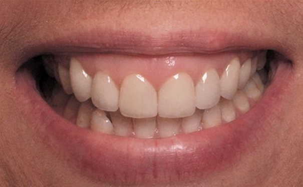 After Patient's Teeth
