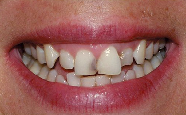 Before Patient's Teeth